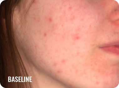Photo of a female face with acne before treatment with WINLEVI