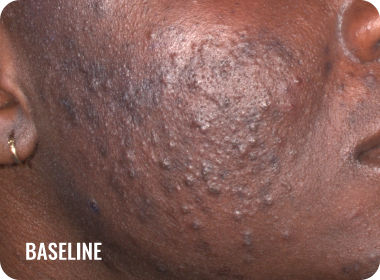 Photo of a female face with acne before treatment with WINLEVI