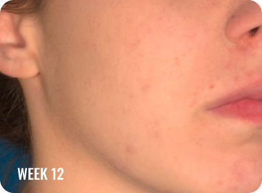 hoto of a female face with clearer skin after treatment with WINLEVI