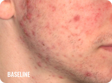 Photo of a male face with acne before treatment with WINLEVI