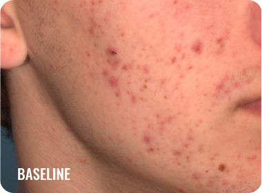 Photo of a male face with acne before treatment with WINLEVI