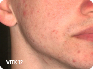 Photo of a male face with clearer skin after treatment with WINLEVI