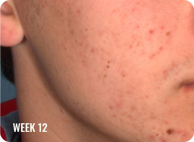 hoto of a female face with clearer skin after treatment with WINLEVI