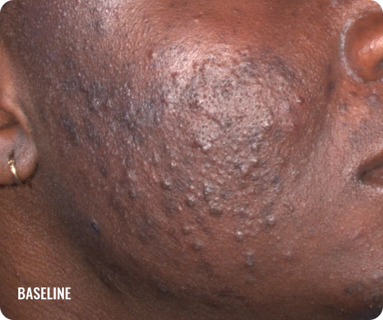 Photo of a female face with acne before treatment with WINLEVI
