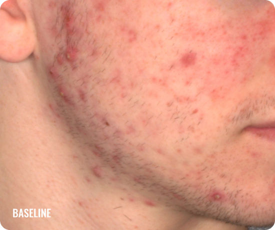 Photo of a male face with acne before treatment with WINLEVI