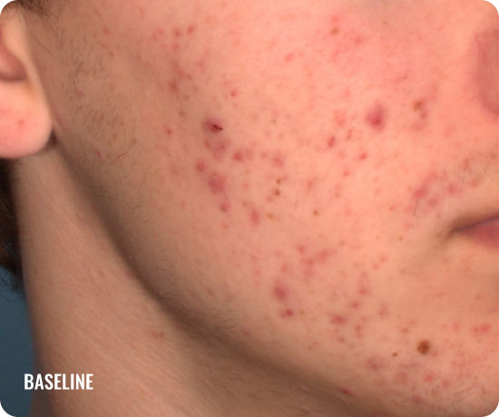 Photo of a male face with acne before treatment with WINLEVI