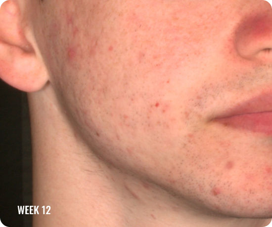 Photo of a male face with clearer skin after treatment with WINLEVI