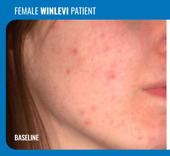 Number 1 Acne Topical - Winlevi