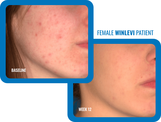 Number 1 Acne Topical - Winlevi