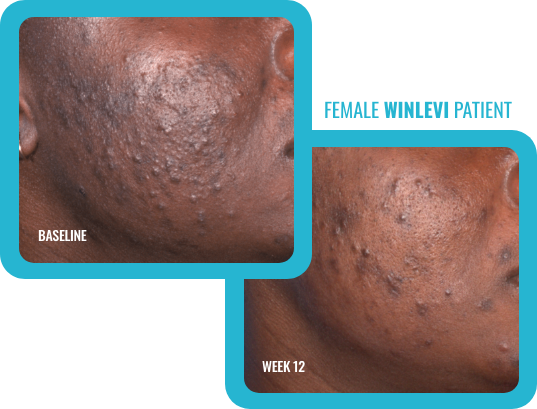 Number 1 Acne Topical - Winlevi