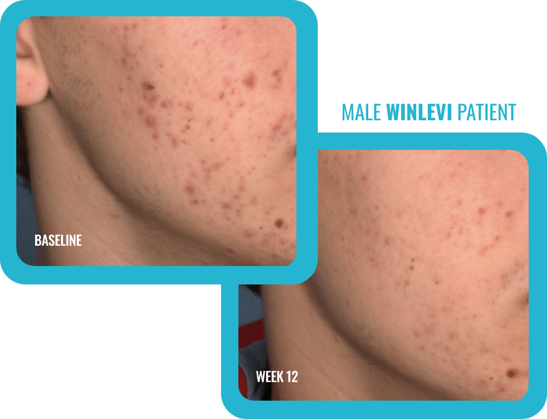 Number 1 Acne Topical Winlevi