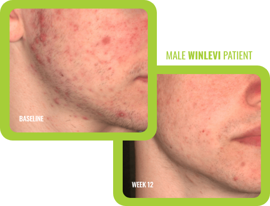 Number 1 Acne Topical - Winlevi